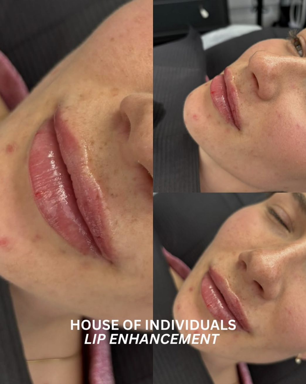 Before and After Lip Enhancements 1