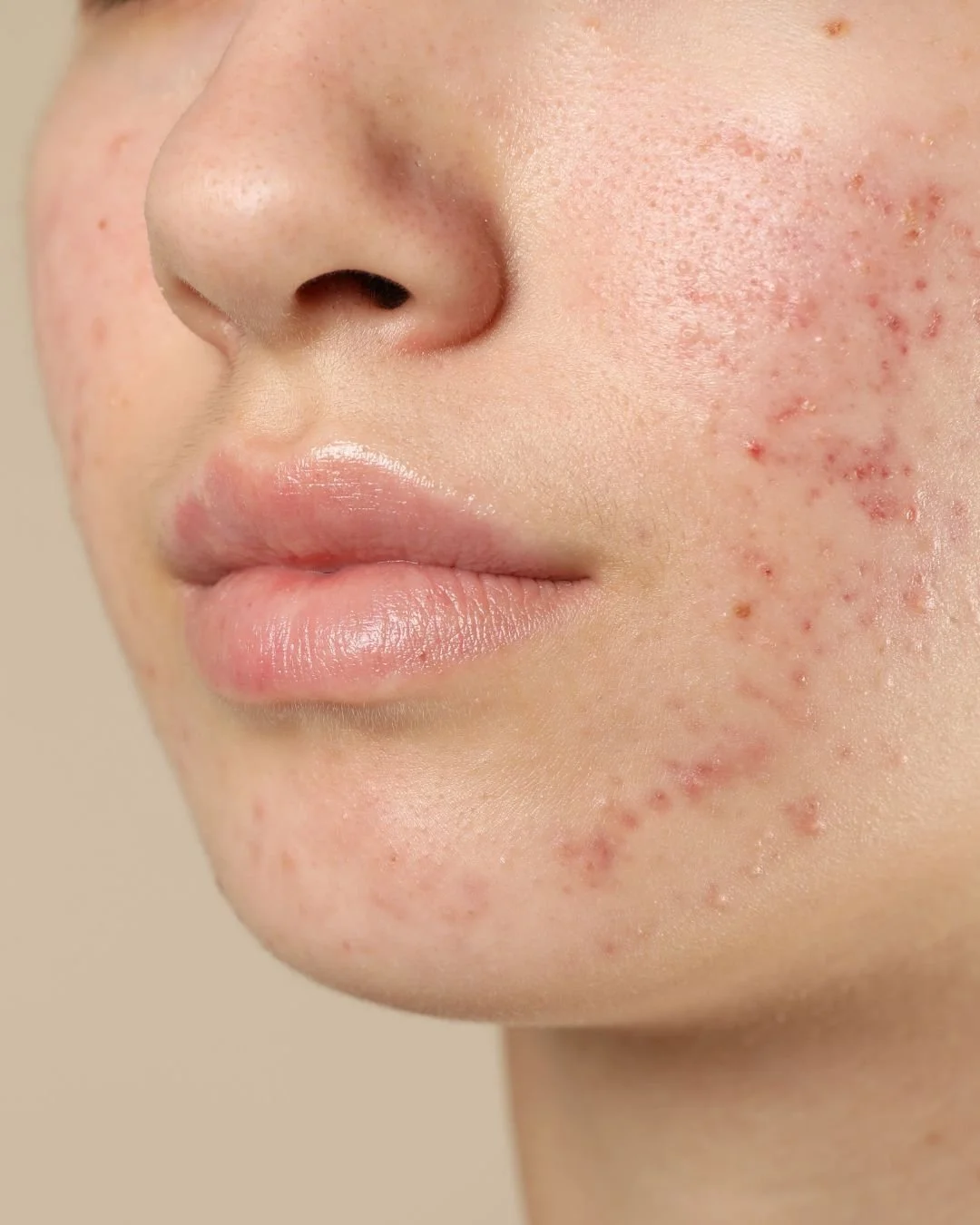 Close-up of a person's face showing skin with acne, pimples, and redness on the cheek and chin.