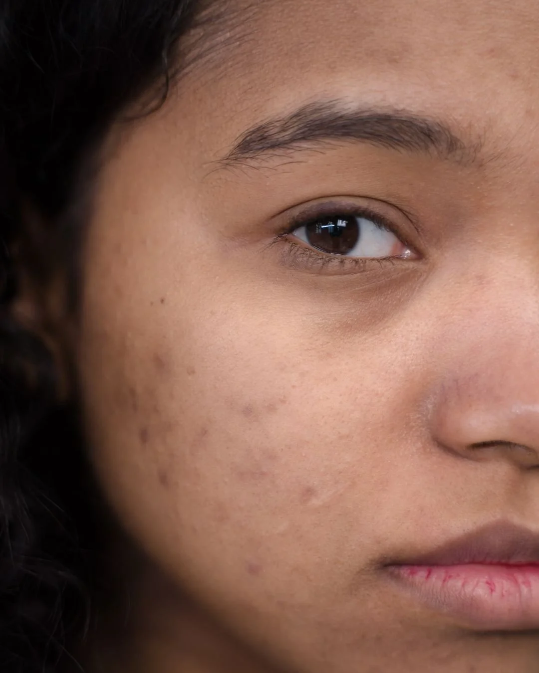 Close-up of a woman's face showing her right eye, eyebrow, and part of her cheek with visible acne and skin texture.