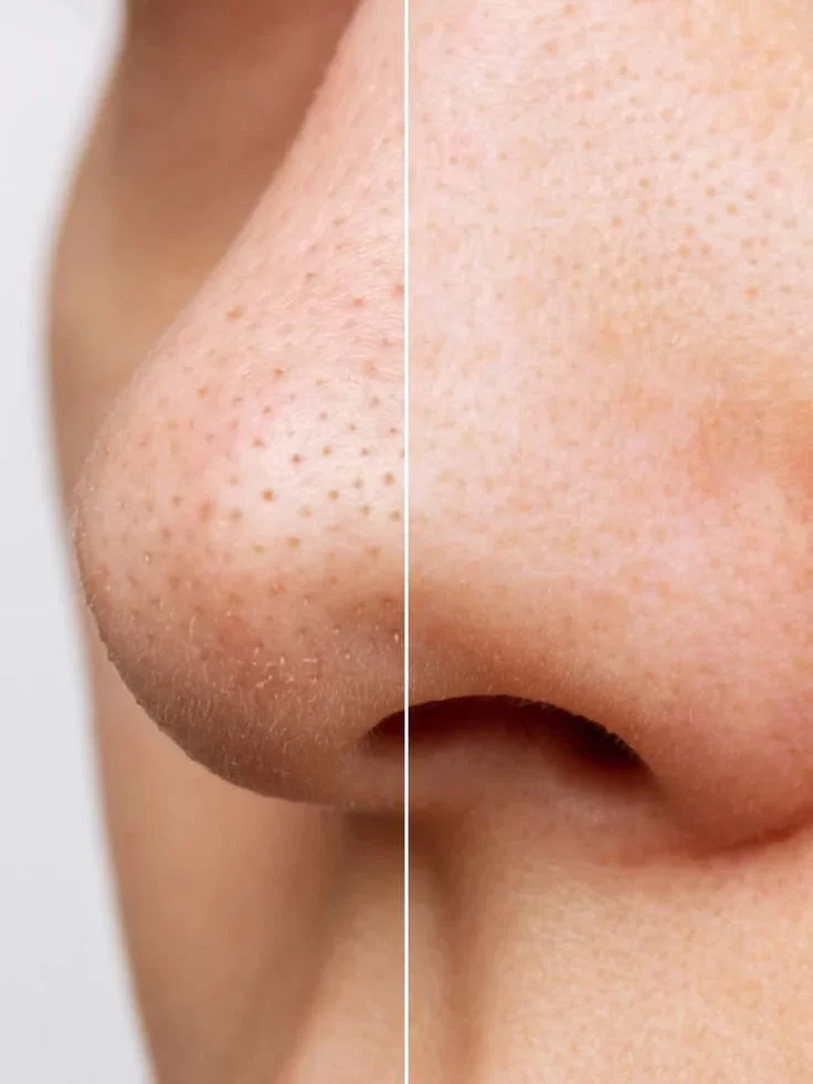 Close-up comparison of a person's nose showing large pores and blackheads on the left, and clearer skin with minimized pores on the right.