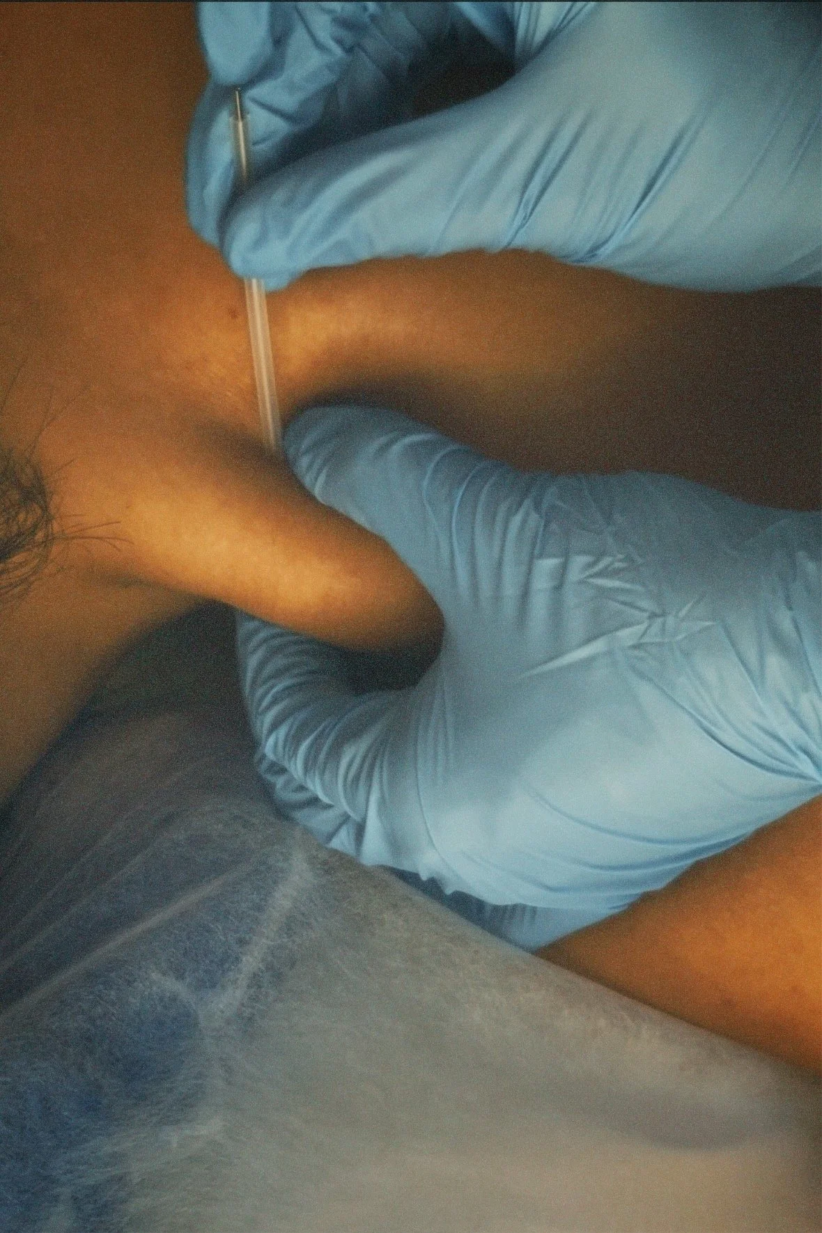 Puncion seca Aravaca.jpg