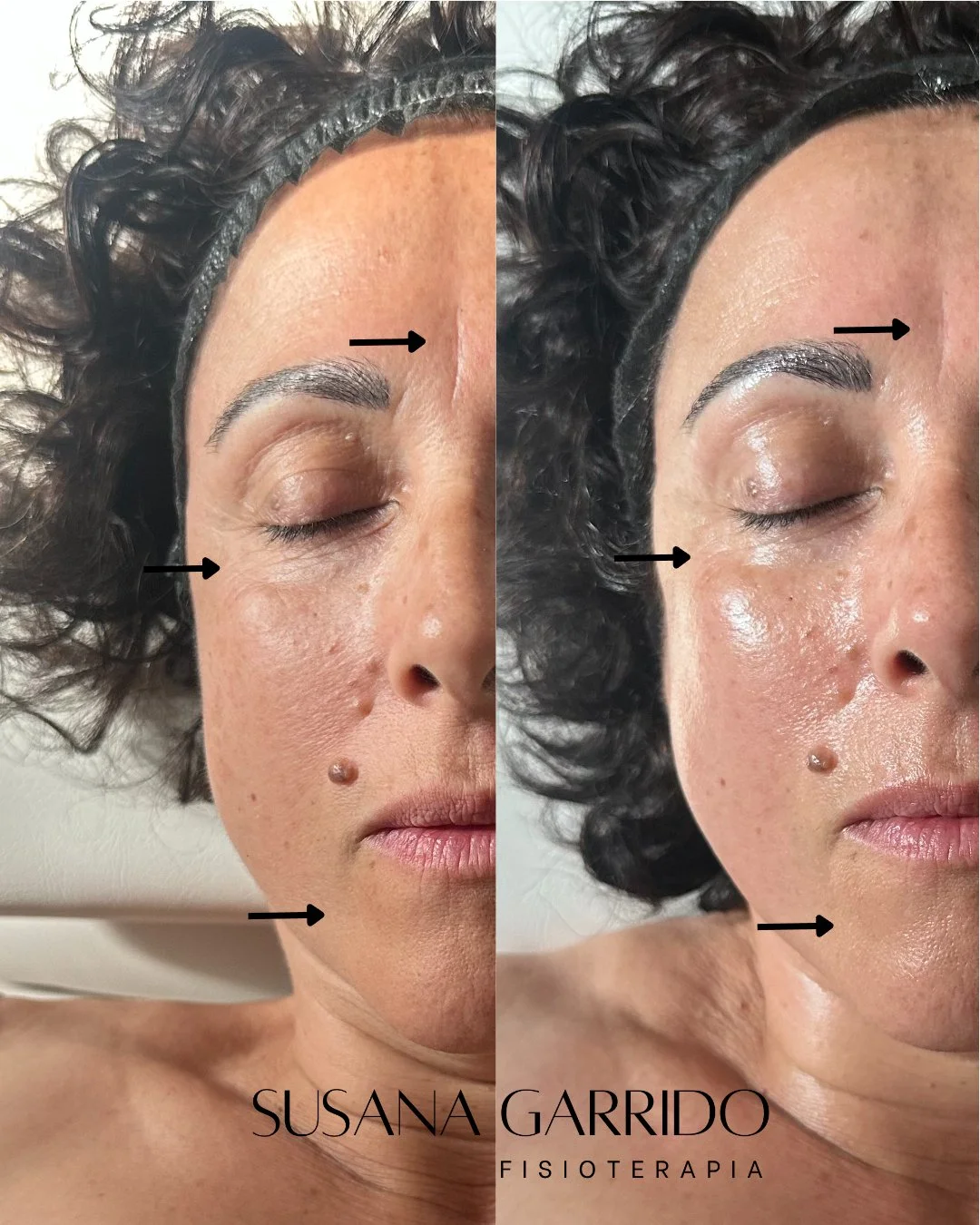 INDIBA facial Aravaca. Fisioestetica Aravaca
