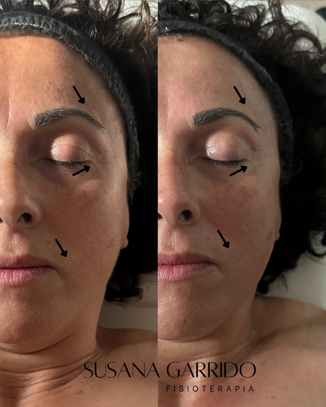 INDIBA facial Aravaca