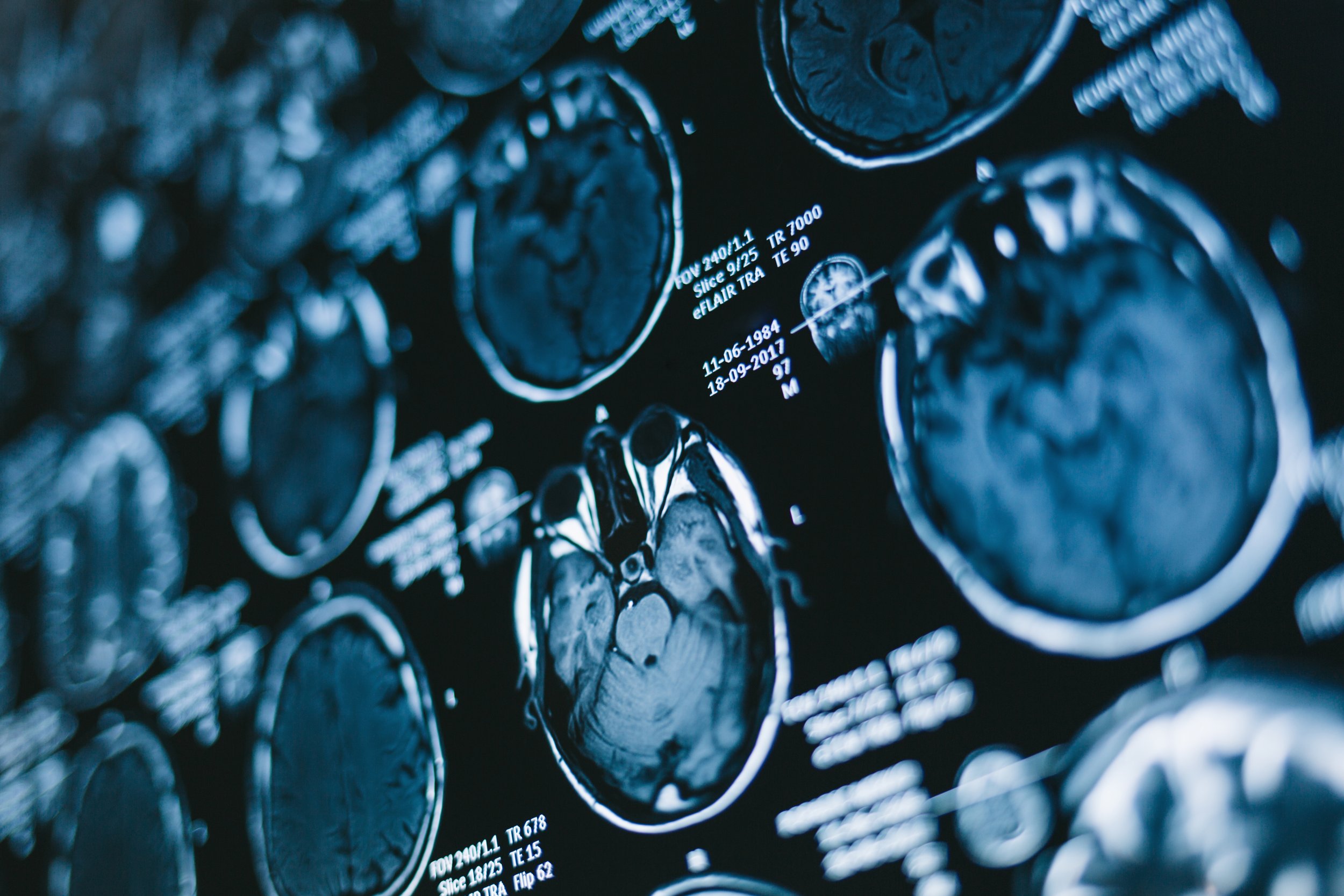 Close-up of MRI brain scans with medical details displayed in white text, showing multiple cross-sectional images of the brain in shades of blue and black.