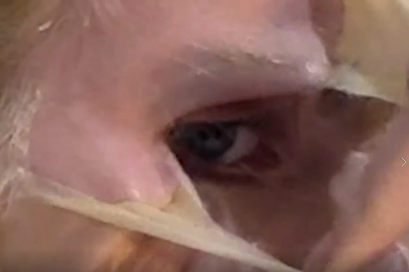 facepeelingsthumbnail.png
