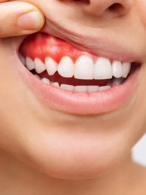 Close-up of a person's mouth showing gums and teeth, with the person pulling up their upper lip to reveal red, irritated gums.