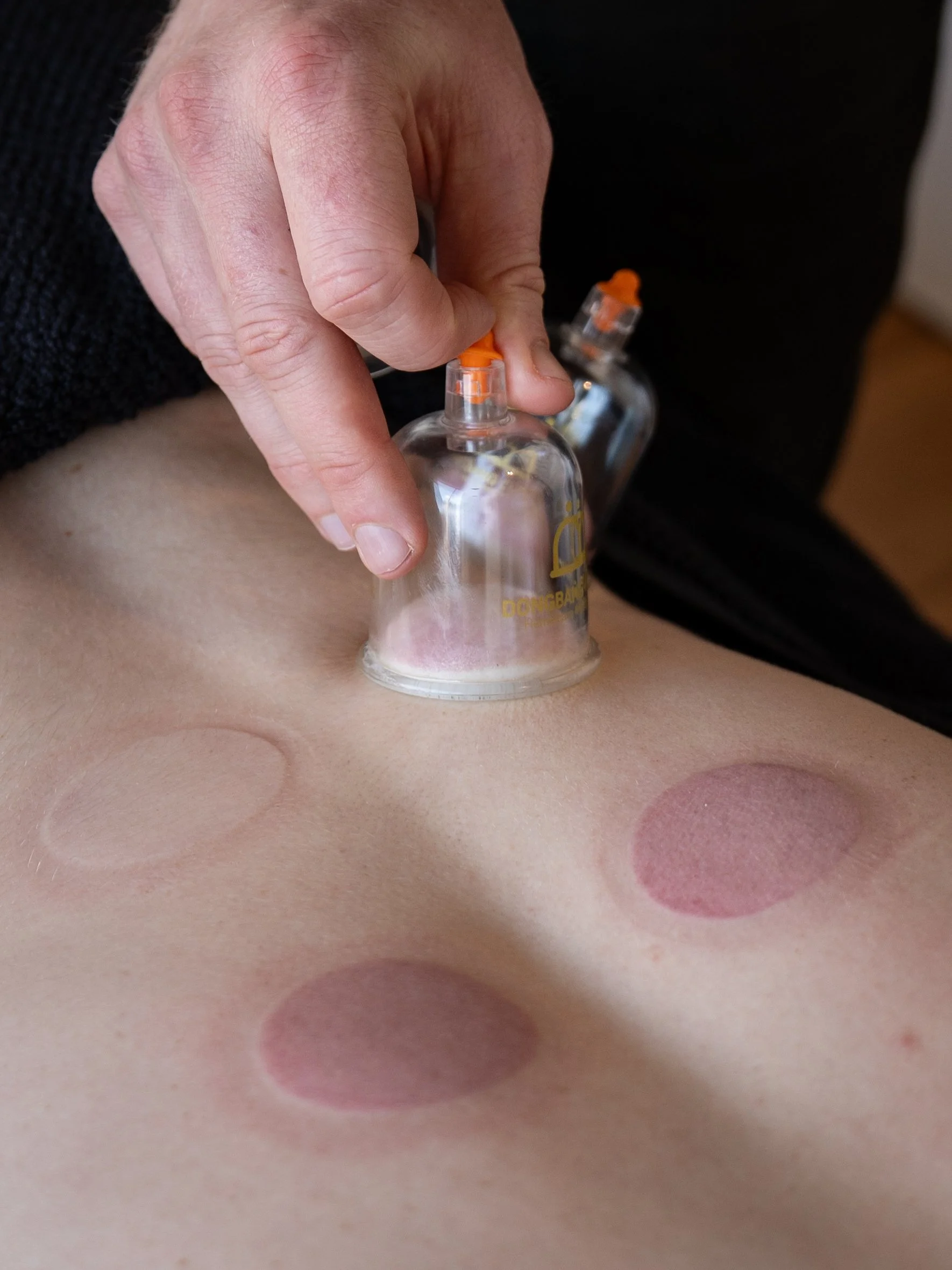 Cupping Therapy: What It Is and How I Use It