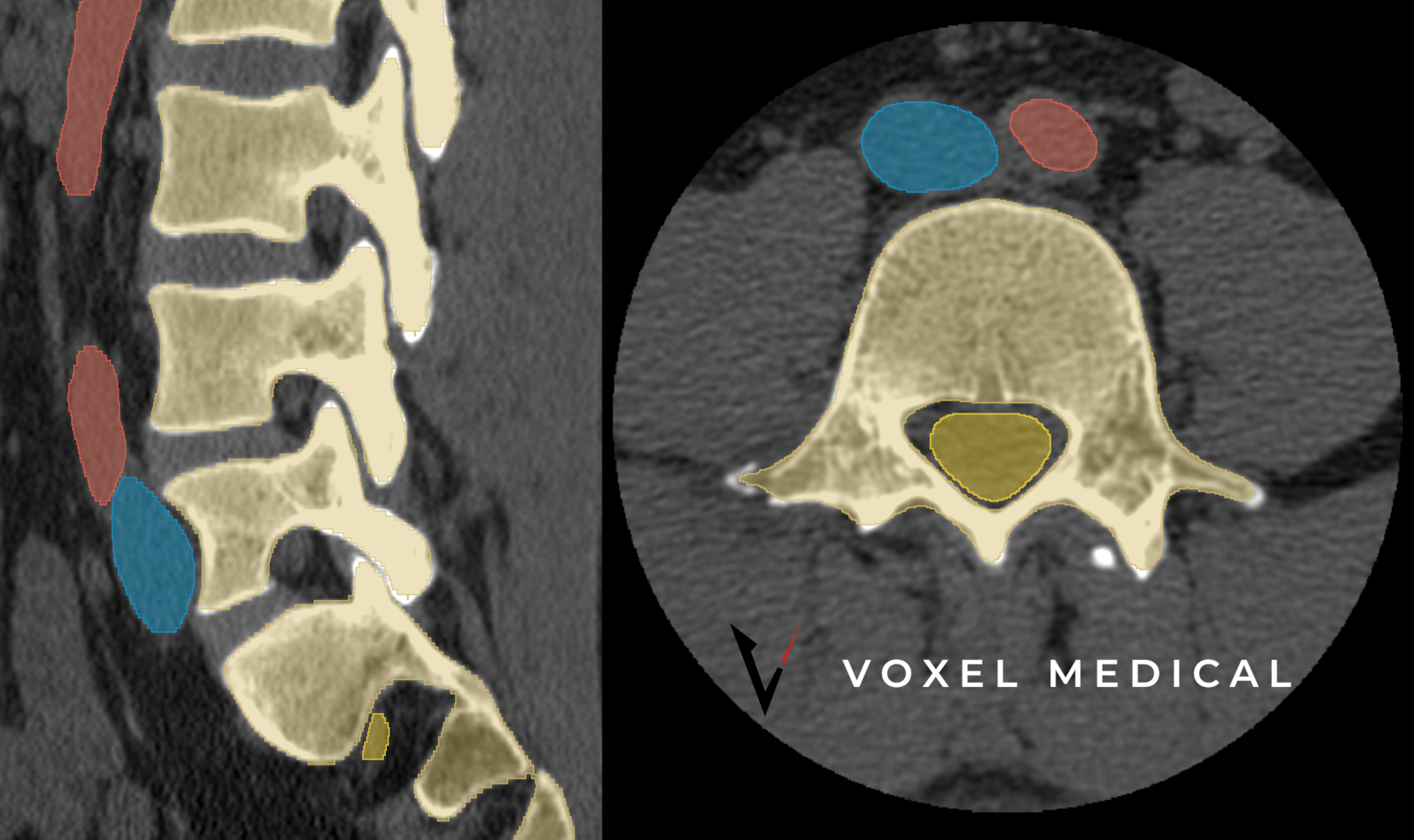 Medical image showing side and cross-sectional views of a human spine with color-coded sections highlighting specific vertebrae and spinal regions, including the cervical, thoracic, and lumbar areas, with labels from Voxel Medical.
