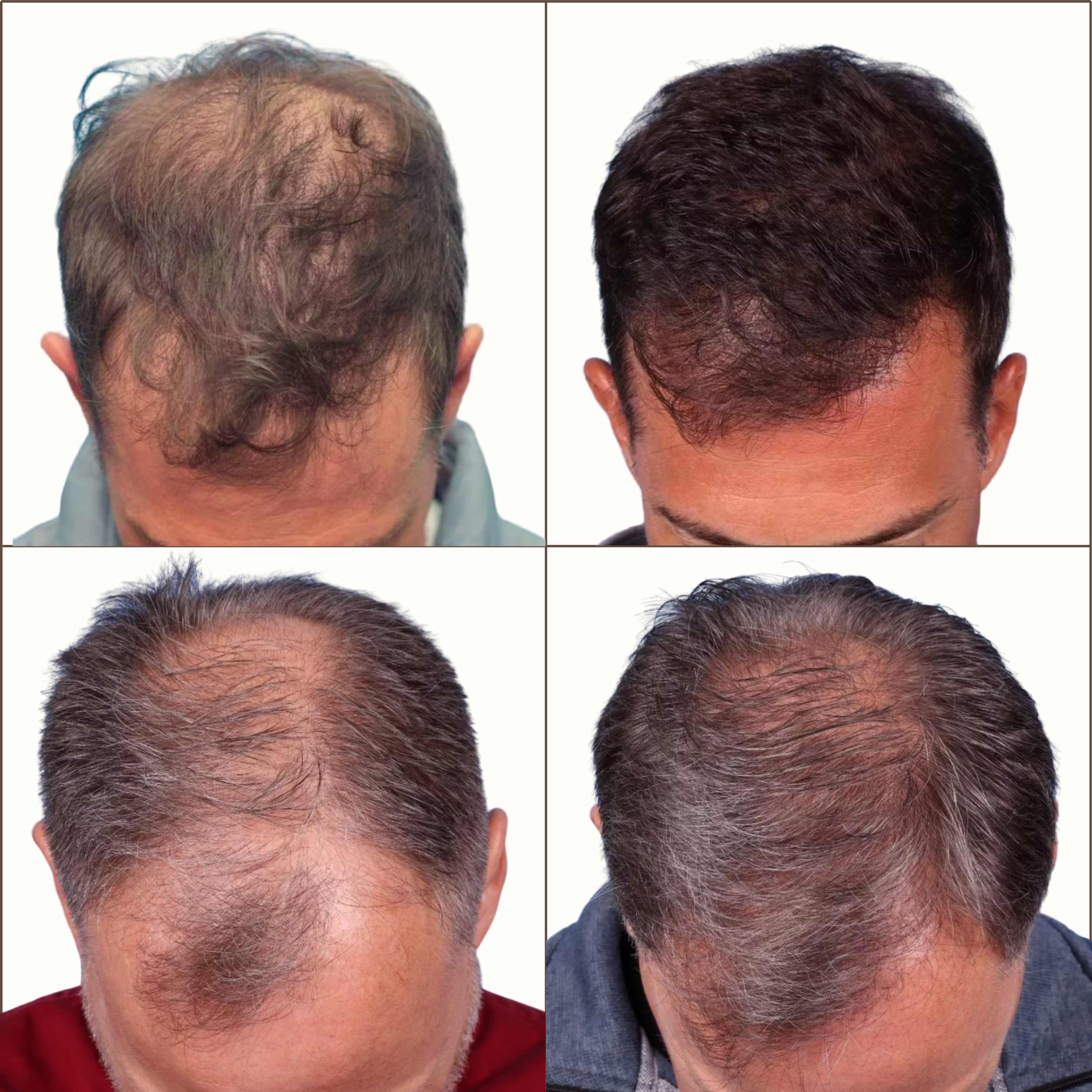 Comparison of before and after images showing hair restoration progress on two individuals, with noticeable hair density improvement.