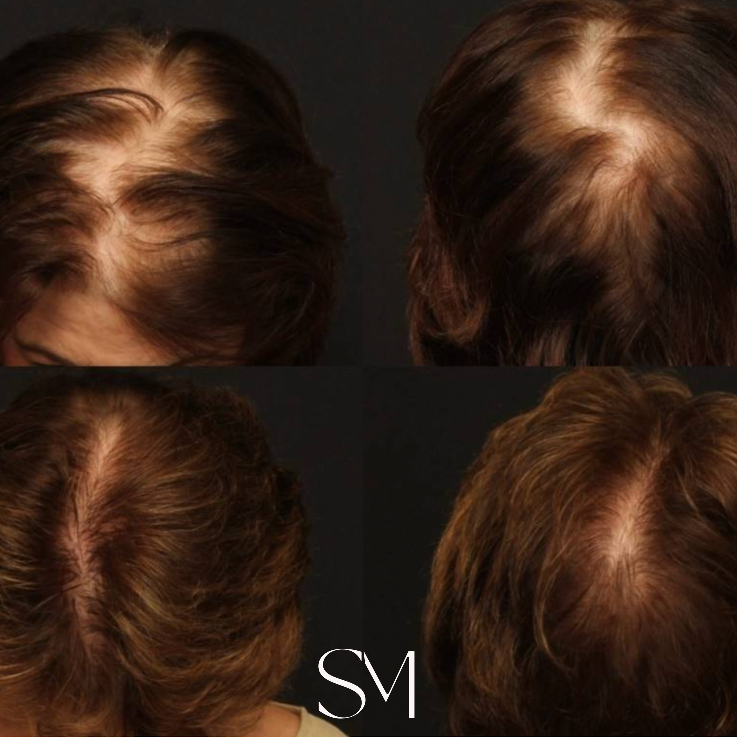 Comparative images of human hair showing progression of hair thinning or hair loss from top view, with varying stages of hair density and scalp visibility.