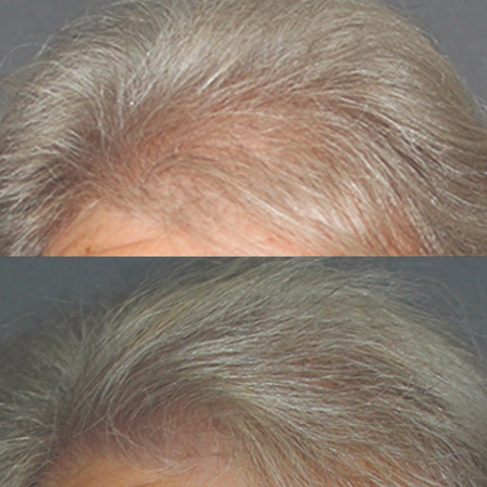 Close-up of a person's scalp with grey hair, showing before and after hair treatment.