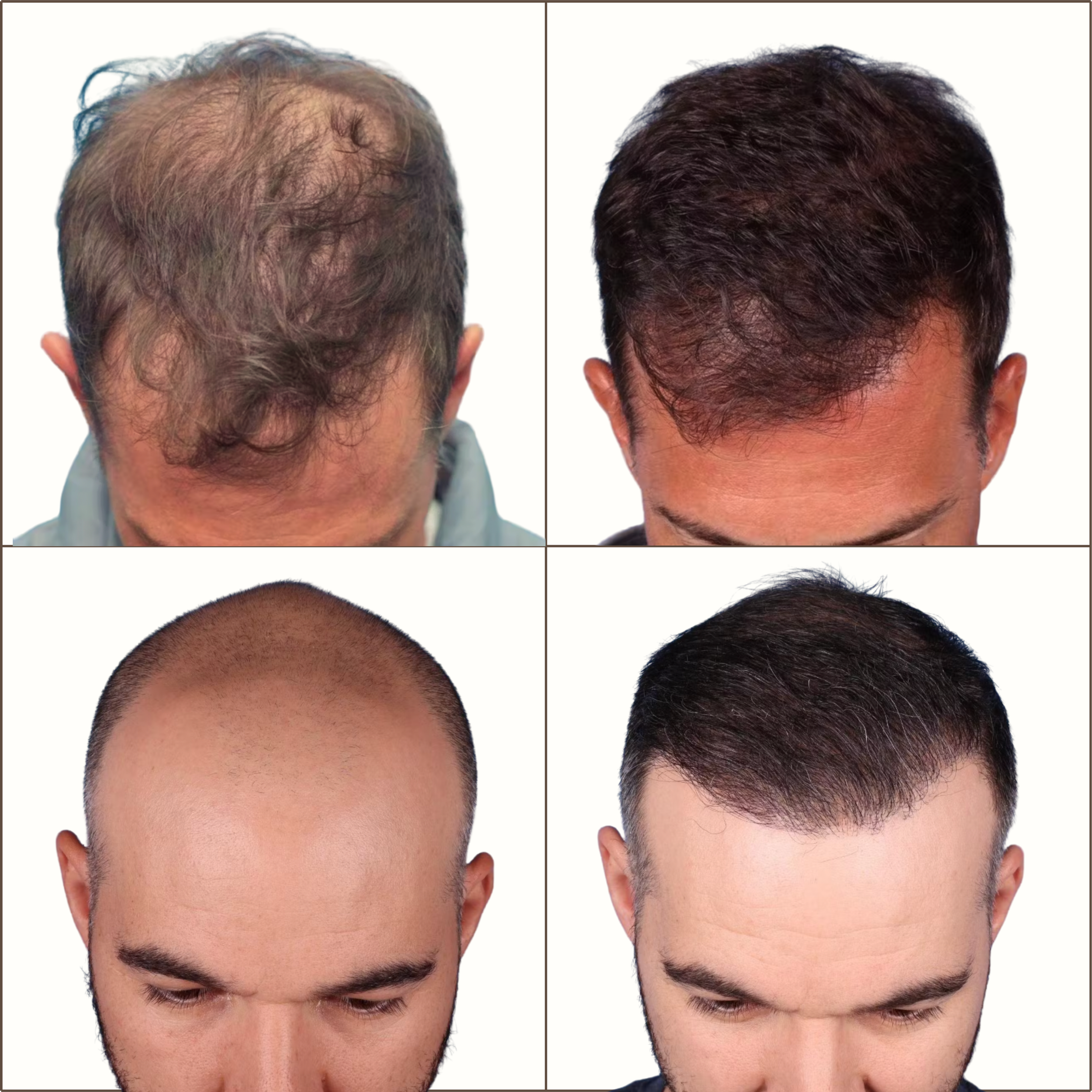Comparison of male hair before and after hair restoration treatments, showing improvements in hair density and coverage.
