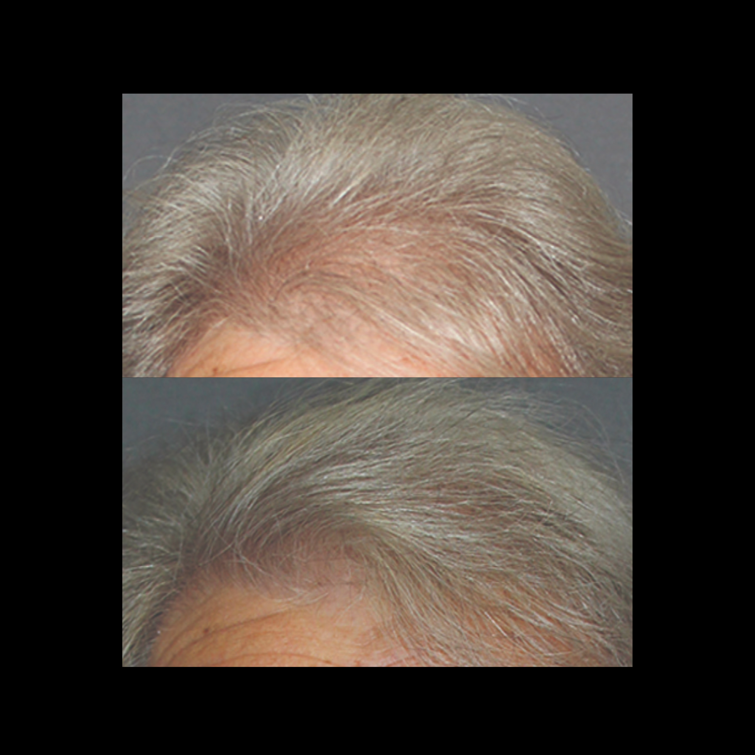 Comparison of gray hair before and after hair treatment in close-up on the scalp.