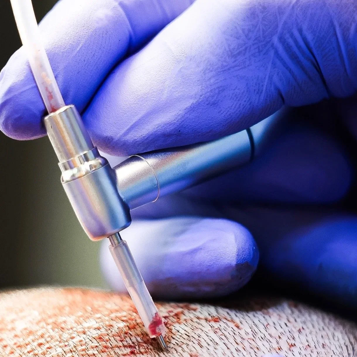 A close-up of a medical professional wearing blue gloves injecting a substance into a patient's skin with a syringe, exemplifying a medical procedure.