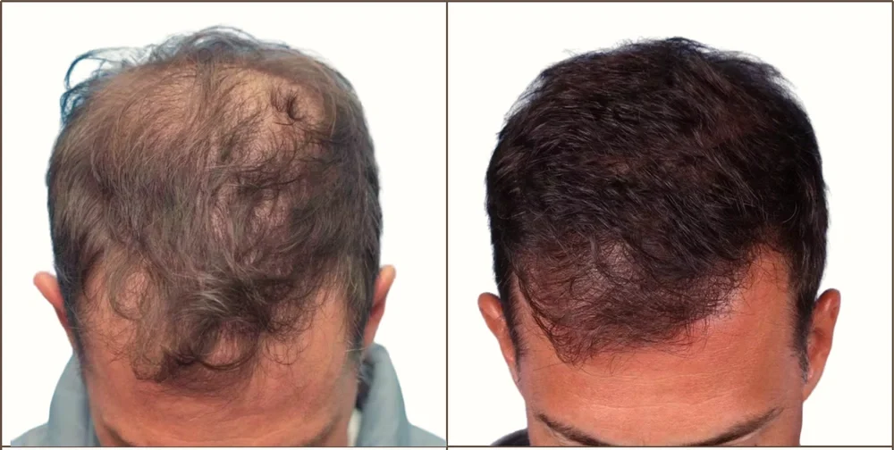 Side-by-side comparison of a man with thinning hair and bald spots on the left, and the same man with a full head of hair on the right.