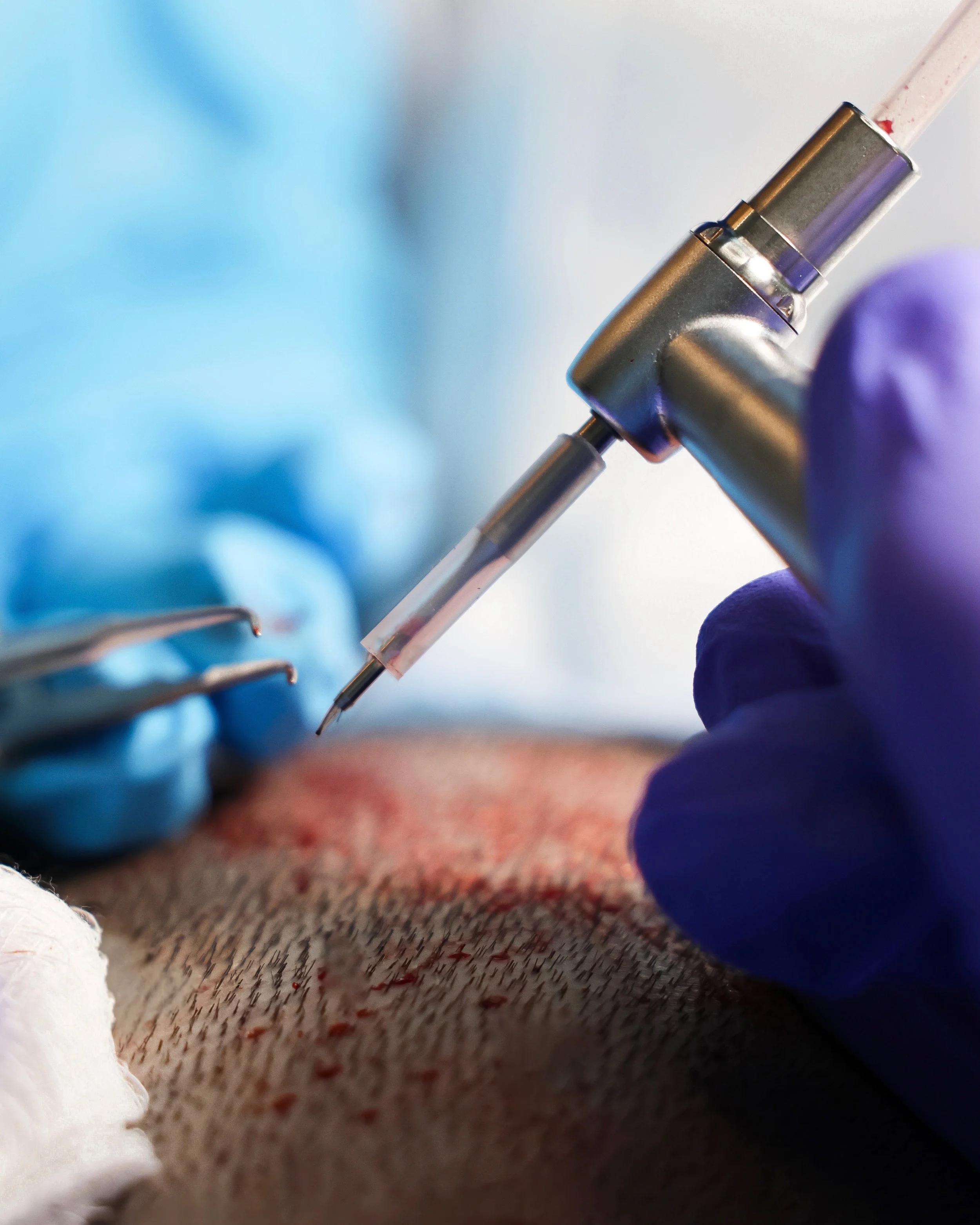 Close-up of a medical procedure, showing a syringe injecting into human skin, with a gloved hand holding the syringe and surgical tools nearby.