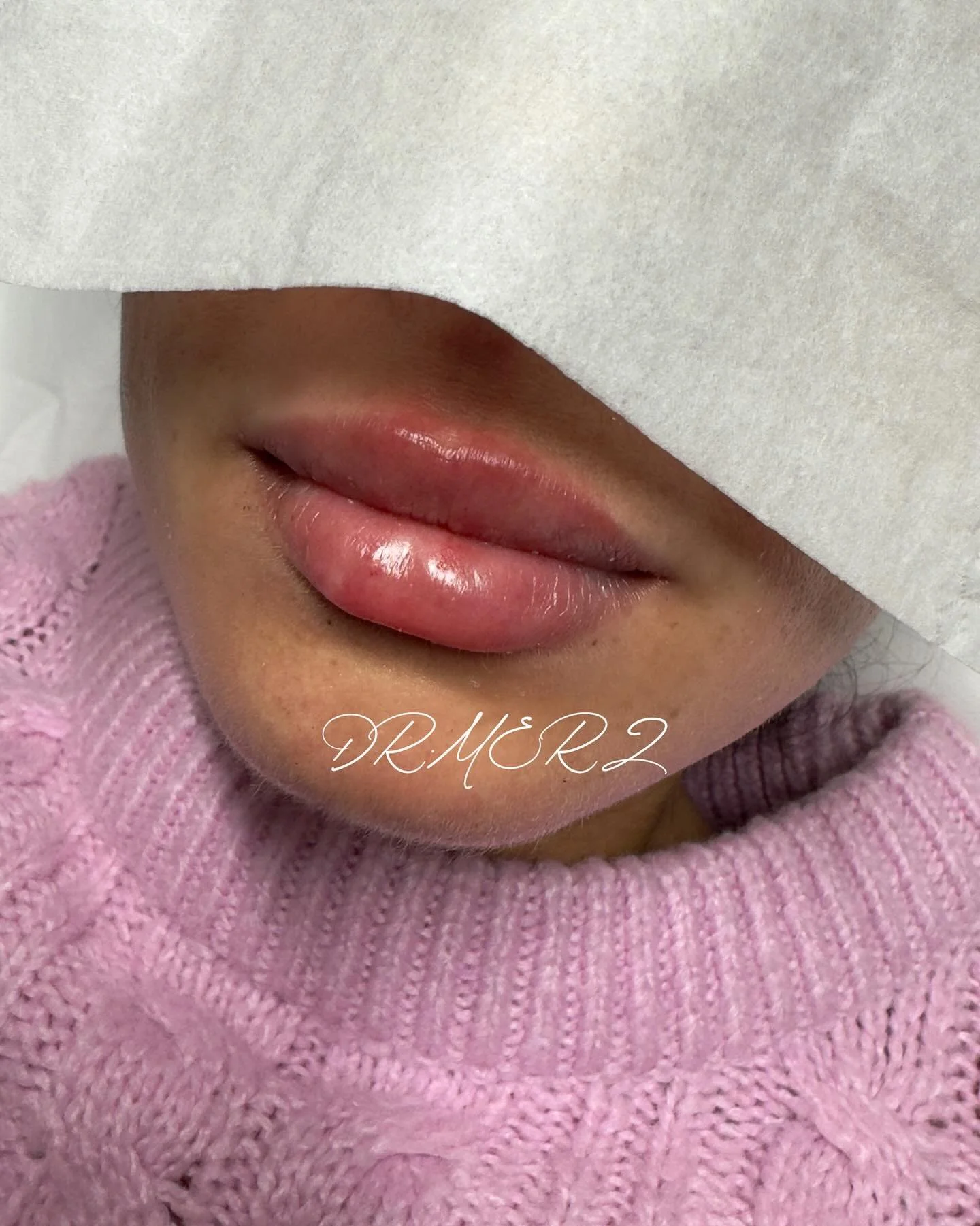 - lips by DR MERZ -

Natural flat lip enhancement with only 0.5 ml.

Buchen Sie Ihren Termin bei DR MERZ direkt &uuml;ber den Link in der Bio.

💉💉💉

#lip #lipfiller #lips #lipinjections #doctor #doctors #drmerz #merz #aesthetic #aestheticmedicine 