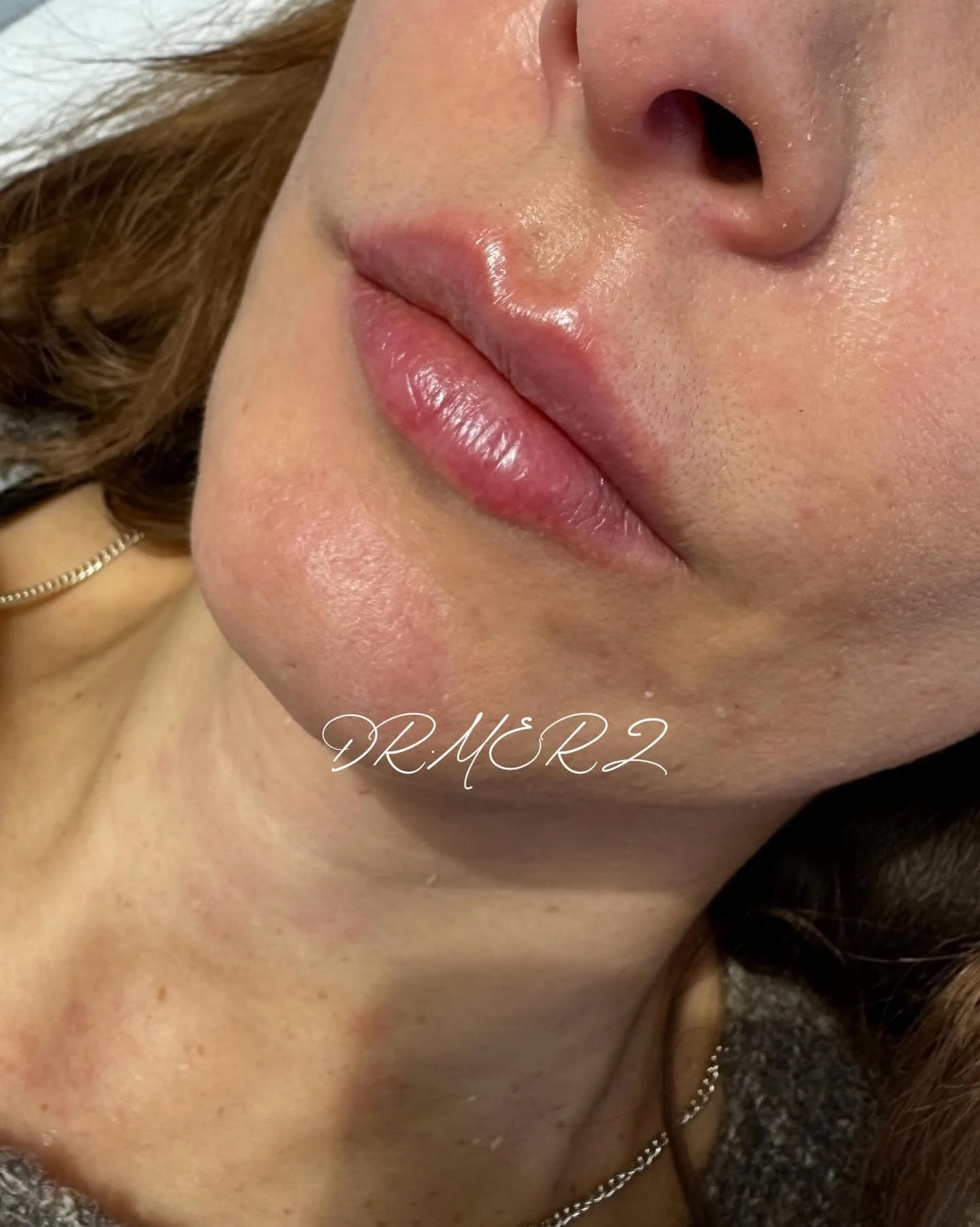 - lips by DR MERZ -

Natural flat lip enhancement with only 0.5 ml.

Buchen Sie Ihren Termin bei DR MERZ direkt &uuml;ber den Link in der Bio.

#lip #lipfiller #lips #doctor #drmerz