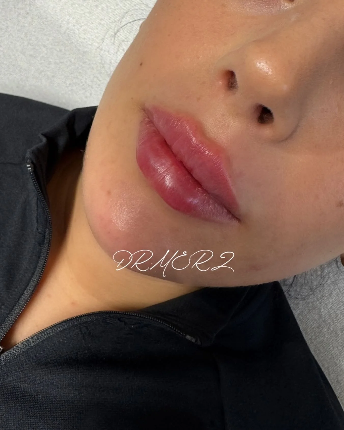 Soft enhancement. Clean contour.
Flat lip technique &ndash; 0.5 ml.

Buchen Sie Ihren Termin bei DR MERZ direkt &uuml;ber den Link in der Bio.

#lip #lipfiller #lips #doctor #drmerz