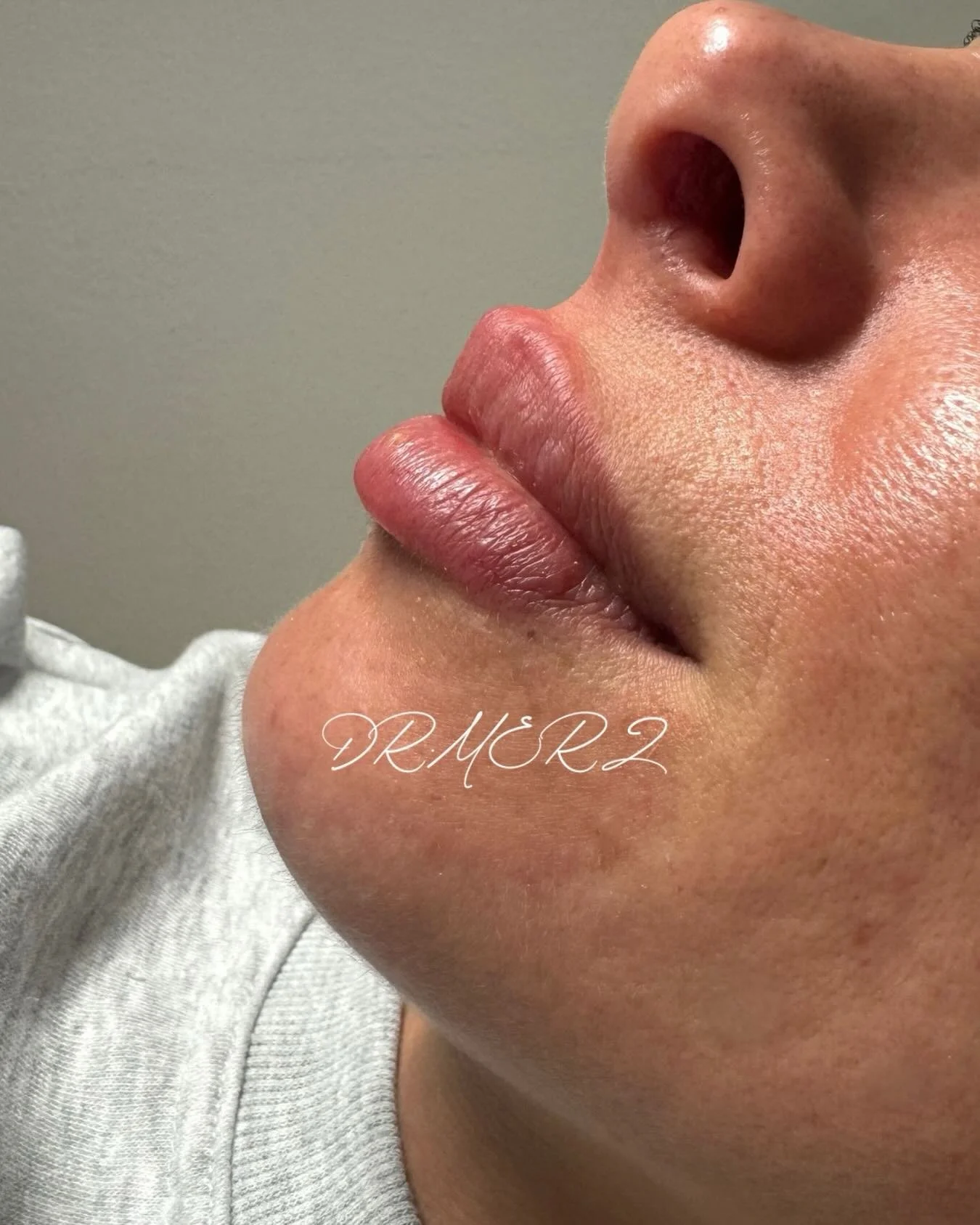 - flat lips by DR MERZ -

Natural flat lip enhancement with only 0.5 ml.

Buchen Sie Ihren Termin bei DR MERZ direkt &uuml;ber den Link in der Bio.

#lip #lipfiller #lips #drmerz #merz