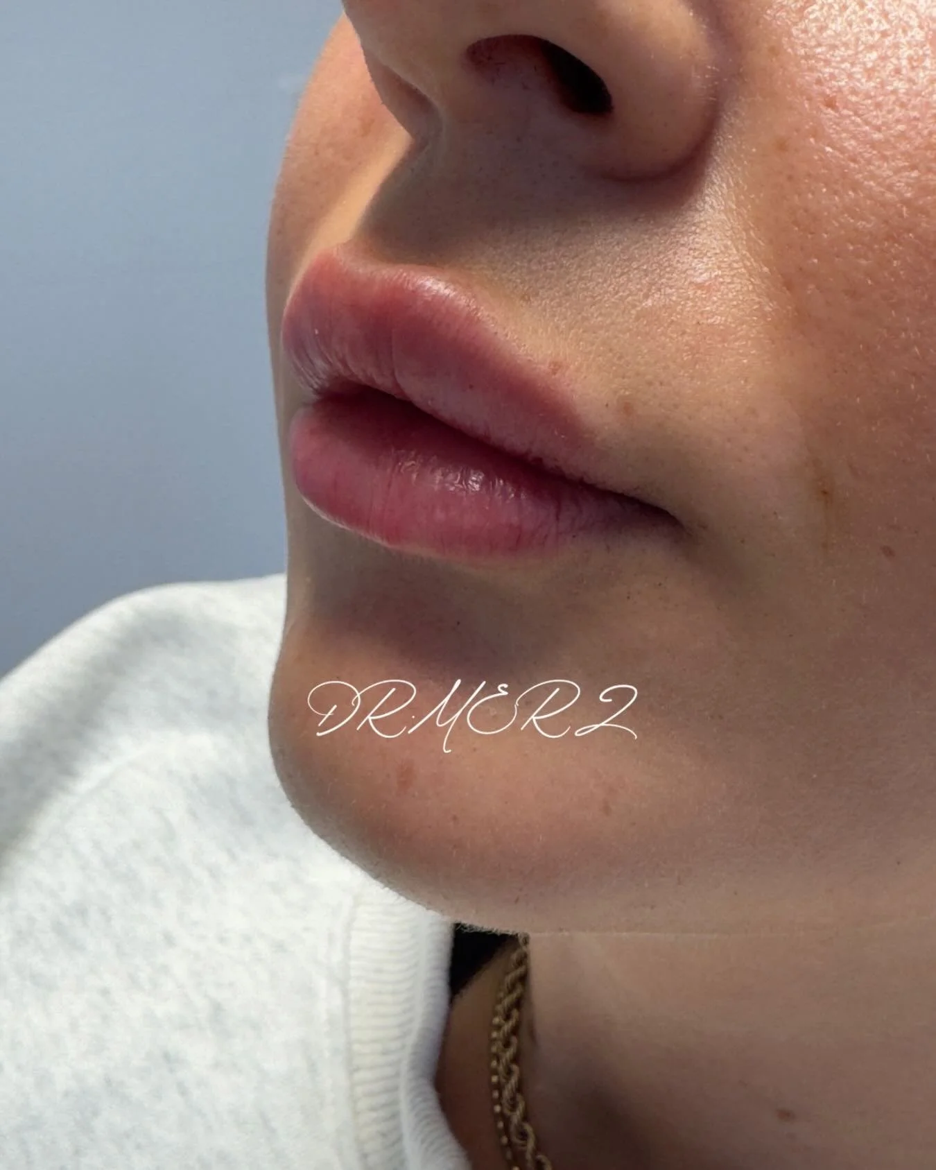 - lips by DR MERZ -

Appliziertes Volumen: 0,5 ml
Arztin: Dr. Merz
Dauer: 50-60 min

Buchen Sie Ihren Termin bei DR MERZ direkt &uuml;ber den Link in der Bio.

💉💉💉

#lip #lipfiller #lips #doctor #drmerz