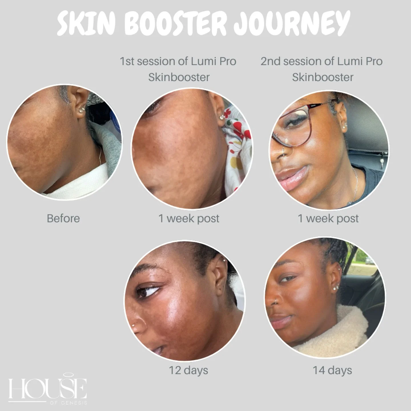 Glowing skin is a journey, and this is what progress looks like!
Cheers to the Lumi Pro Skinbooster treatment plan 🥂:
	•	Clearer Skin 
	•	Brighter complexion
	•	Visible hydration and glow
From day 1 to 2 weeks post-treatment, the sk