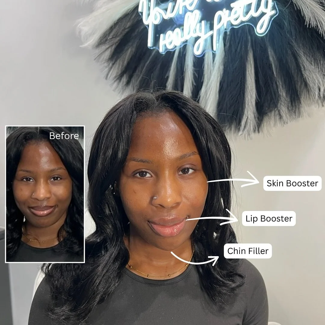 This beauty received Skin Booster, Lip Booster, and Chin Filler for a naturally enhanced, radiant look. The results? Subtle, balanced, and oh-so-glowy!
📍House of Genesis.