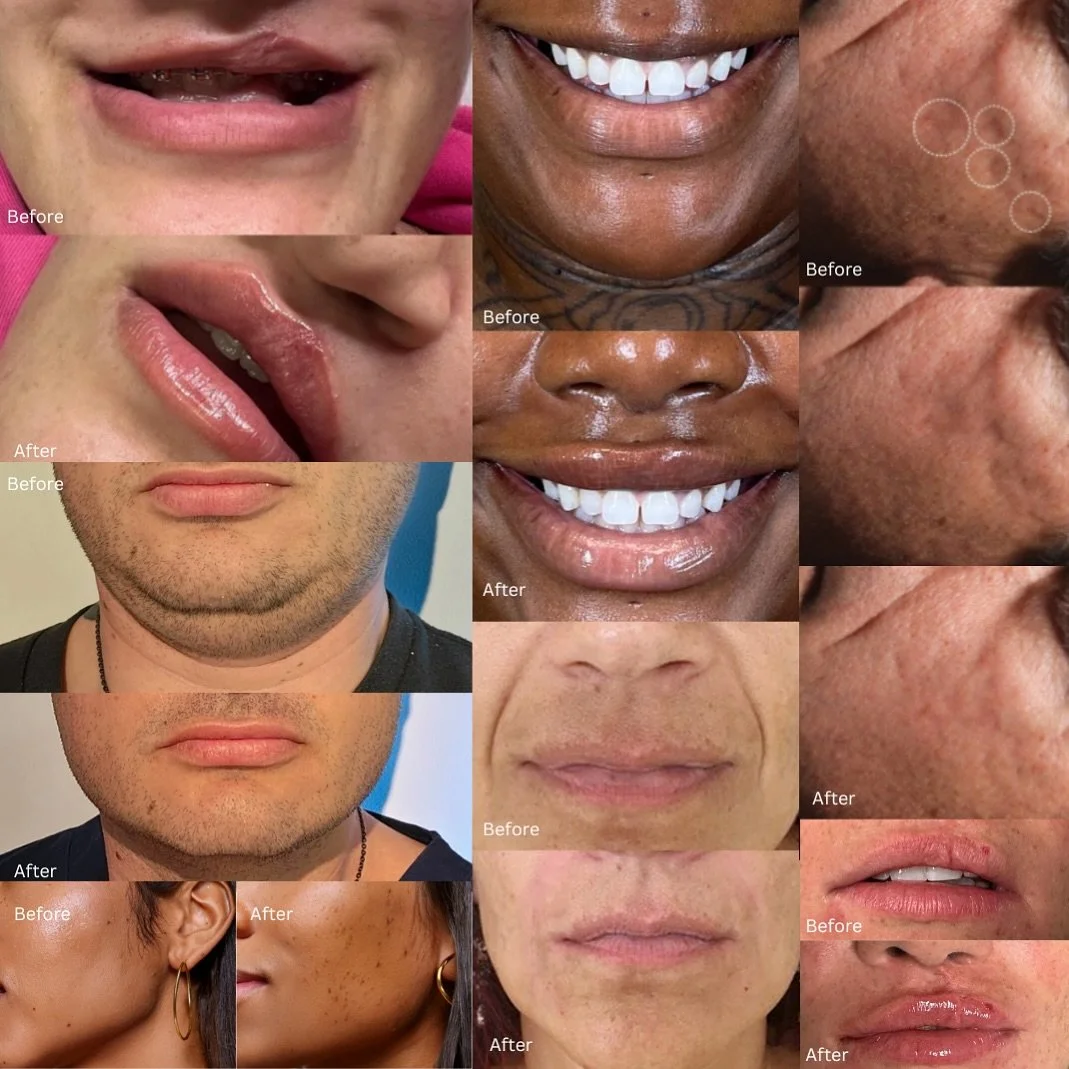 Cosmetic and aesthetic treatments are often seen solely as beauty enhancements, but for many, they’re about addressing deep insecurities. I came across a powerful story of a woman with a cleft lip who sought lip filler treatment after years of