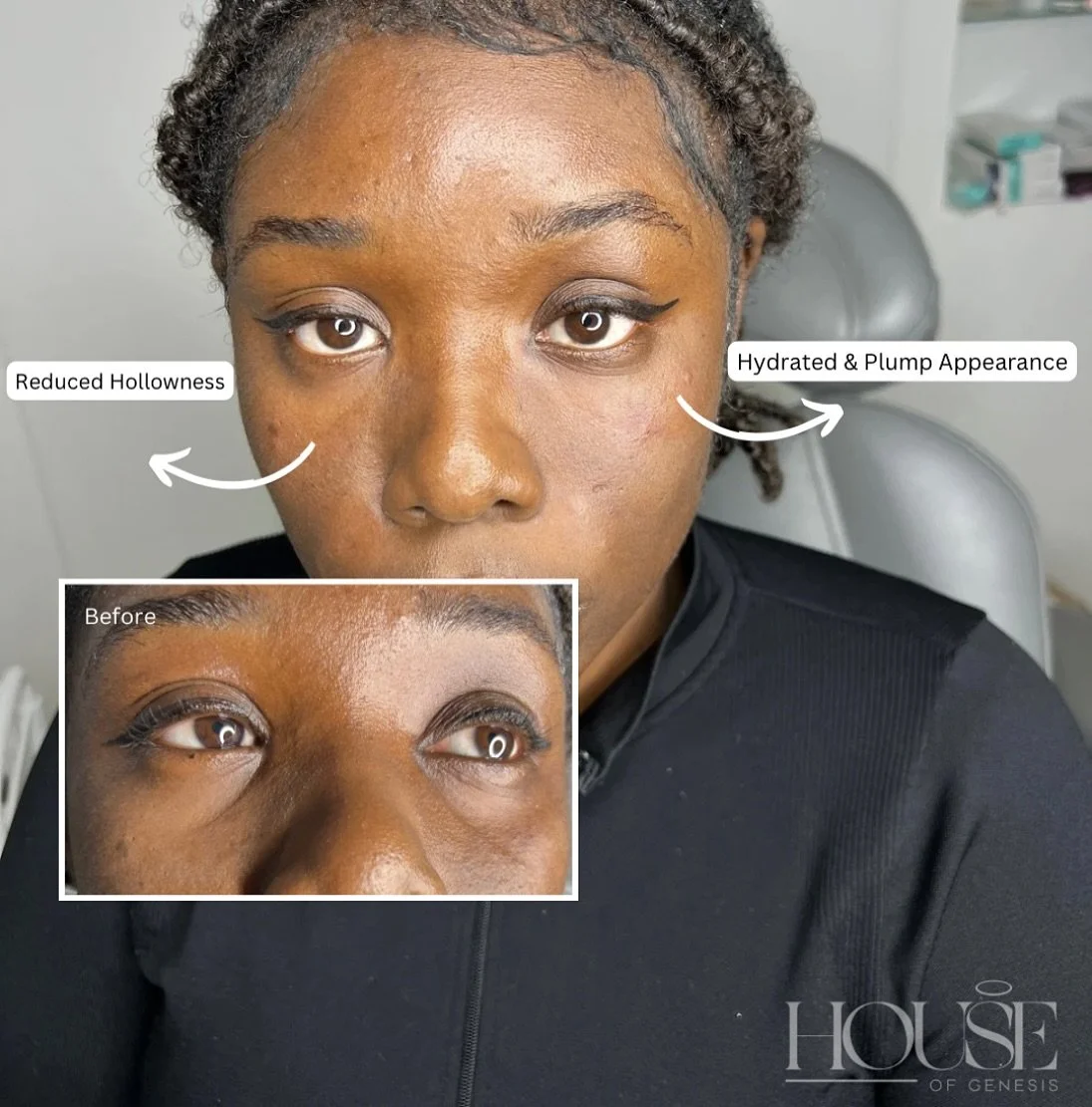 ✨ Goodbye Tired Eyes✨
Our tear trough filler treatment reduces hollowness and restores volume. 
🔹 Hydrated & plump under-eyes
🔹 Reduced dark shadows
🔹 Natural, refreshed appearance
📍House of Genesis