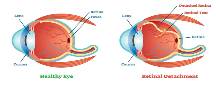 Comparison between a healthy eye and an eye with retinal detachment, showing the lens, cornea, retina, fovea, and detached retina.