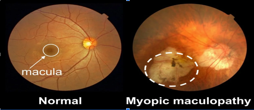 Comparison of a healthy retina with a macula and a retina with myopic maculopathy showing damaged retinal tissue and a large choroidal neovascular membrane.
