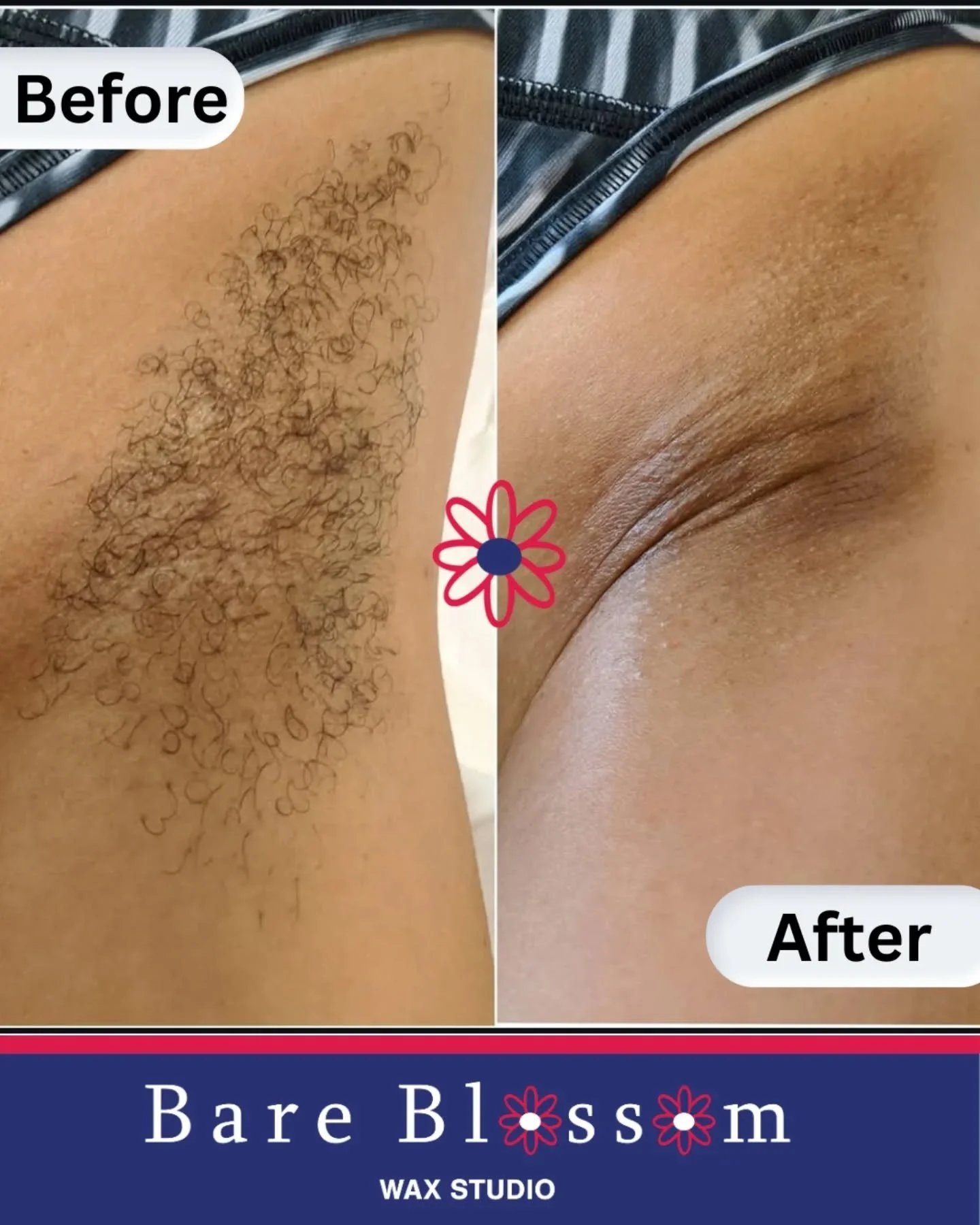When you wax your underarms, the hair grows back finer, softer, and slower.
Because the root is removed, regrowth takes longer and often becomes less dense with consistent appointments.
A perfect option if you&rsquo;re tired of daily shaving! 

📆Boo