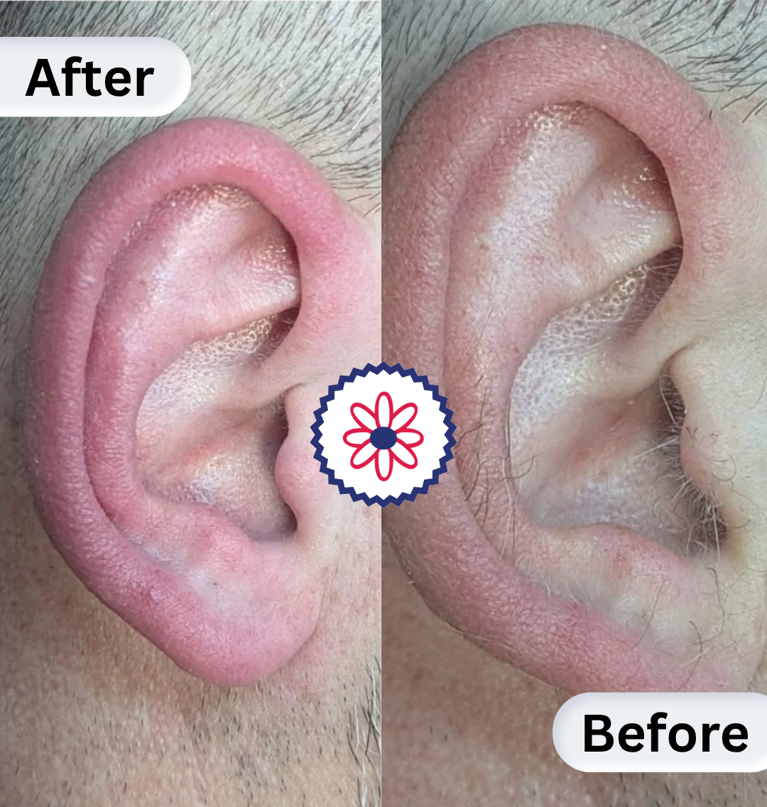 Before and after ear waxing results showing smooth, clean skin with unwanted hair removed.