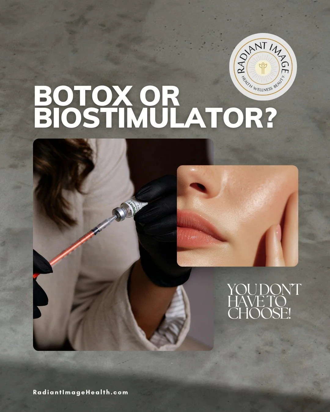 Botox works.
But it&rsquo;s only half the picture.

Because what ages the face isn&rsquo;t just movement...it&rsquo;s volume loss, collagen decline, and skin laxity.
That&rsquo;s where biostimulators come in.

While Botox keeps dynamic lines fr