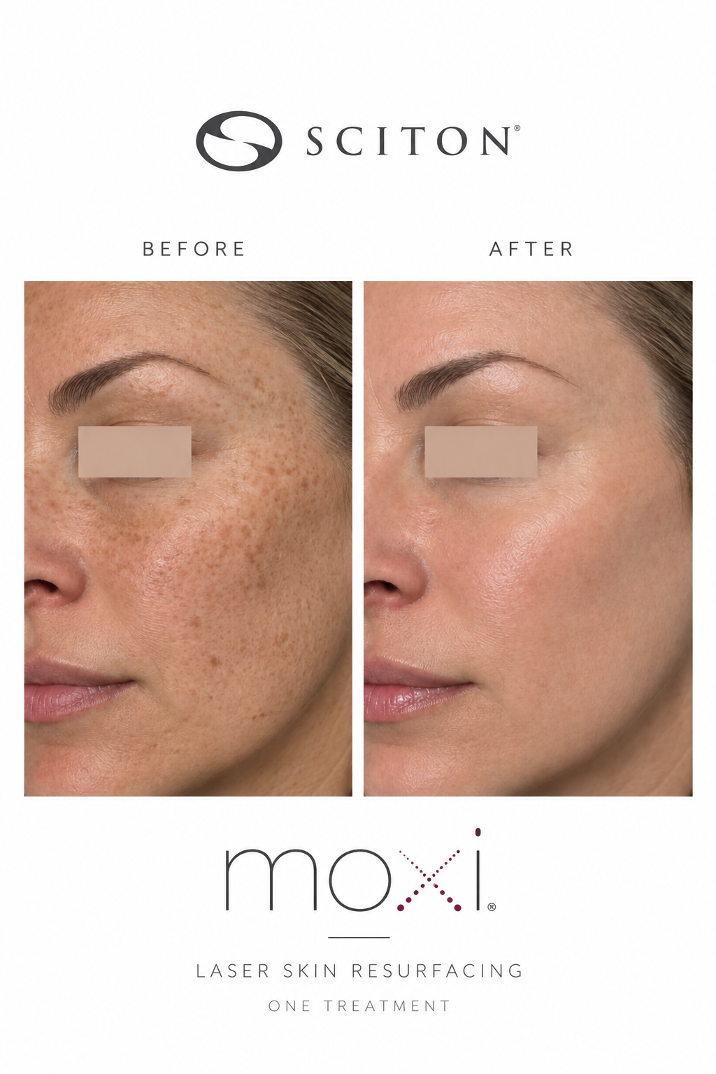 Before and after one skin resurfacing treatment