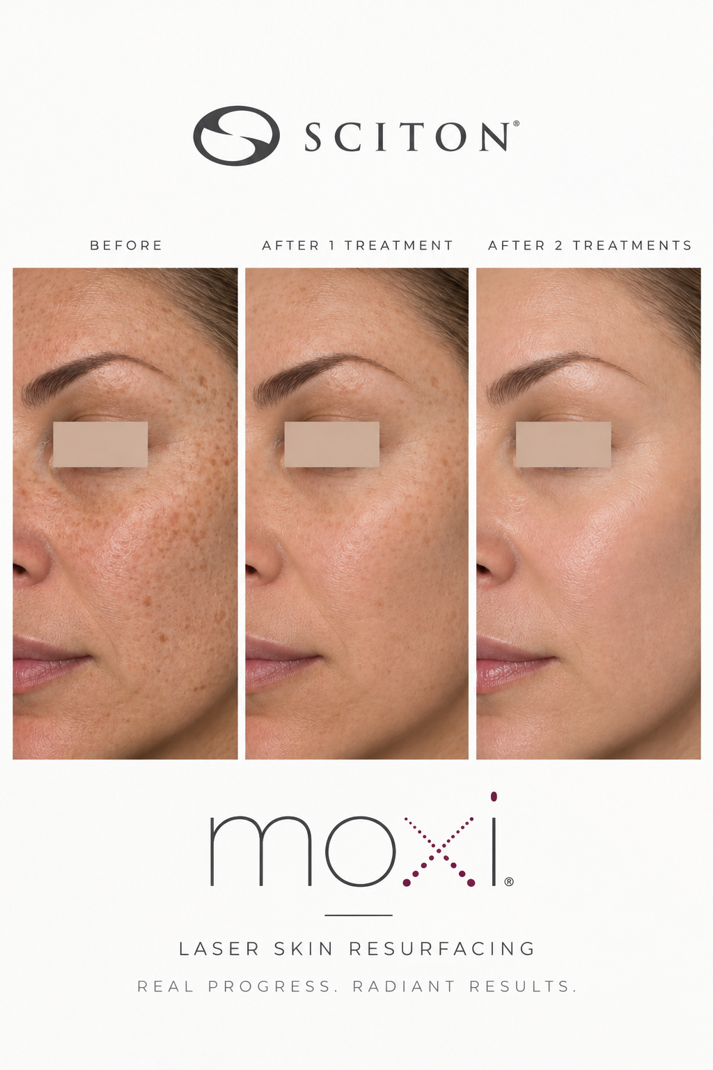 Skin appearance before treatment, after one treatment, and after two treatments