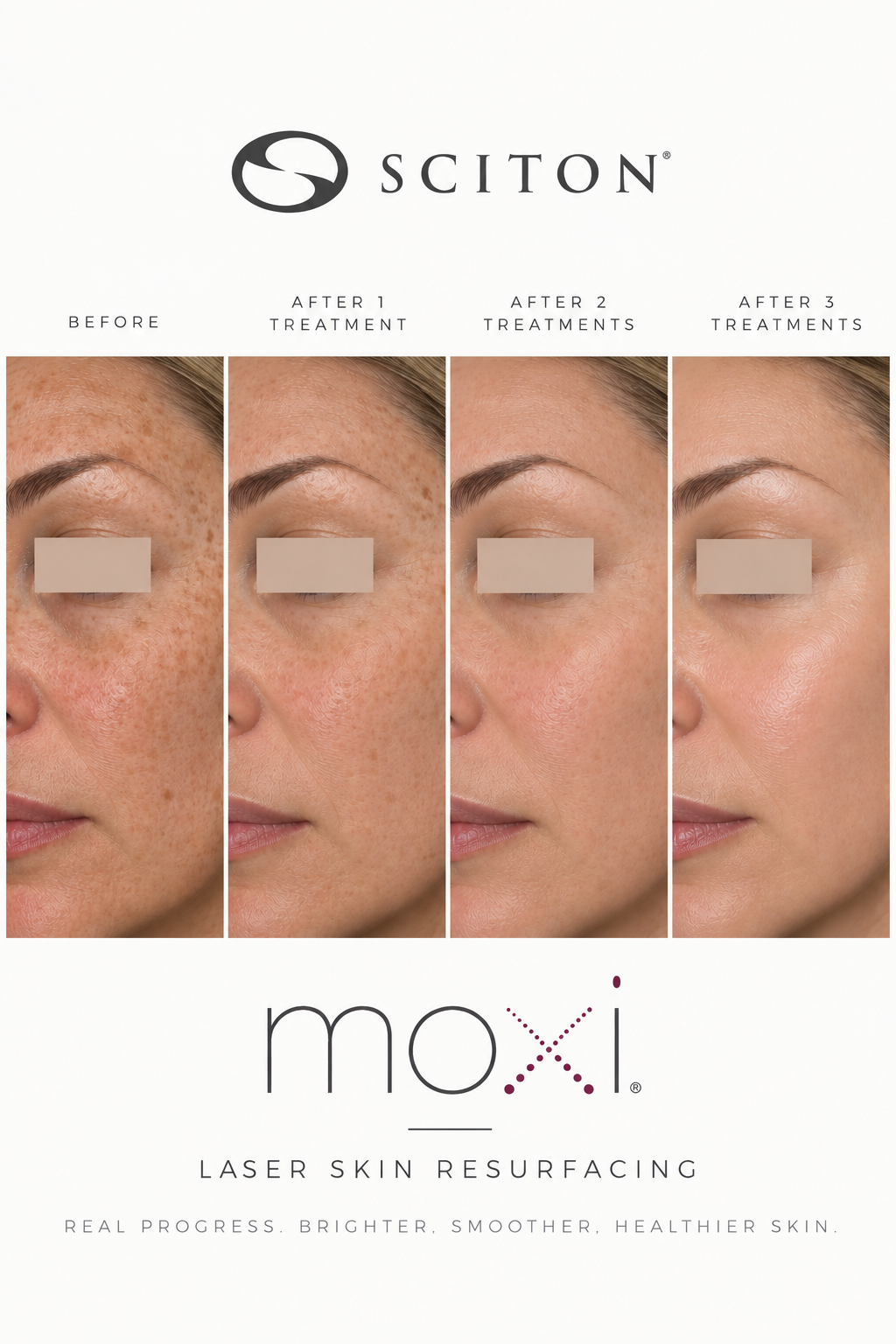 Skin appearance before treatment and after one, two, and three treatments
