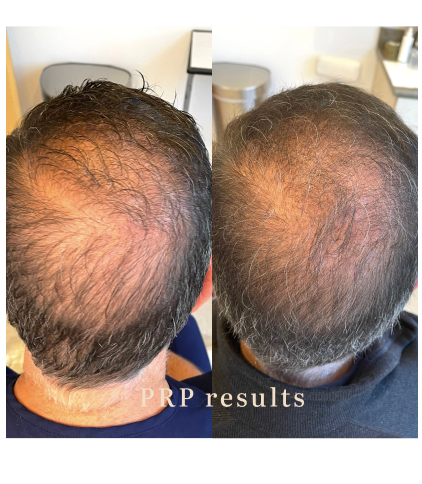 Side-by-side comparison of a man's bald scalp before and after PRP treatment, showing increased hair density.