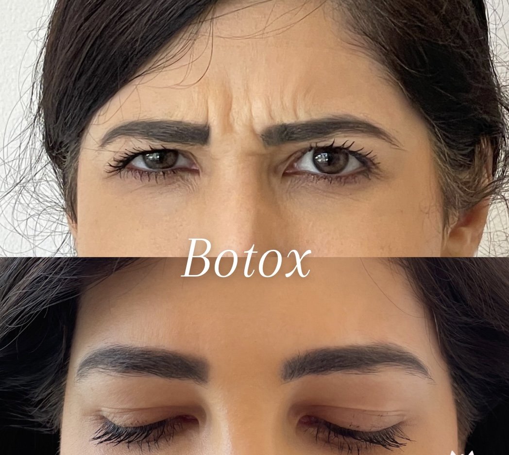 Forehead lines before and after neuromodulator (Botox) treatment at NuVie MD, Irvine