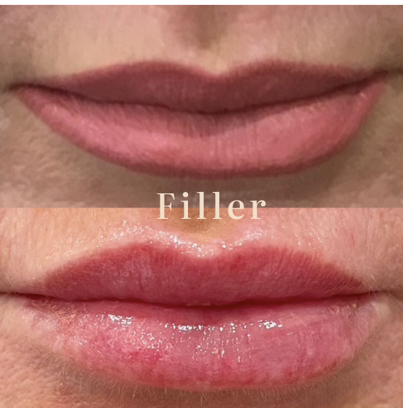 Lip filler before and after at NuVie MD, Irvine — hyaluronic acid filler, results at 2 weeks