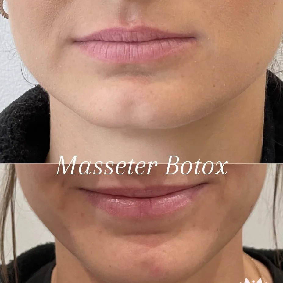 Lip filler before and after at NuVie MD, Irvine — Masseter Botox treatment. results at 2 weeks