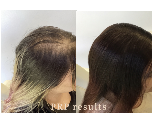 Side-by-side comparison of hair before and after PRP treatment, showing improved hair density and shine.