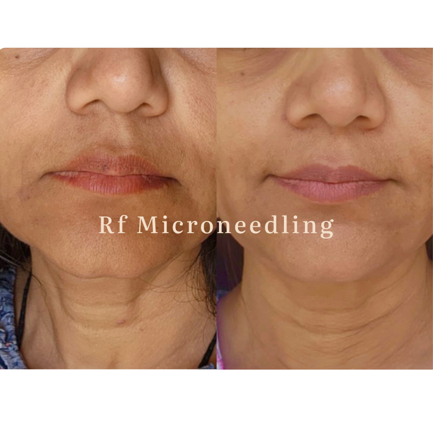 Side-by-side comparison of a woman's face before and after RF microneedling treatment, showing improved skin texture and reduced wrinkles.