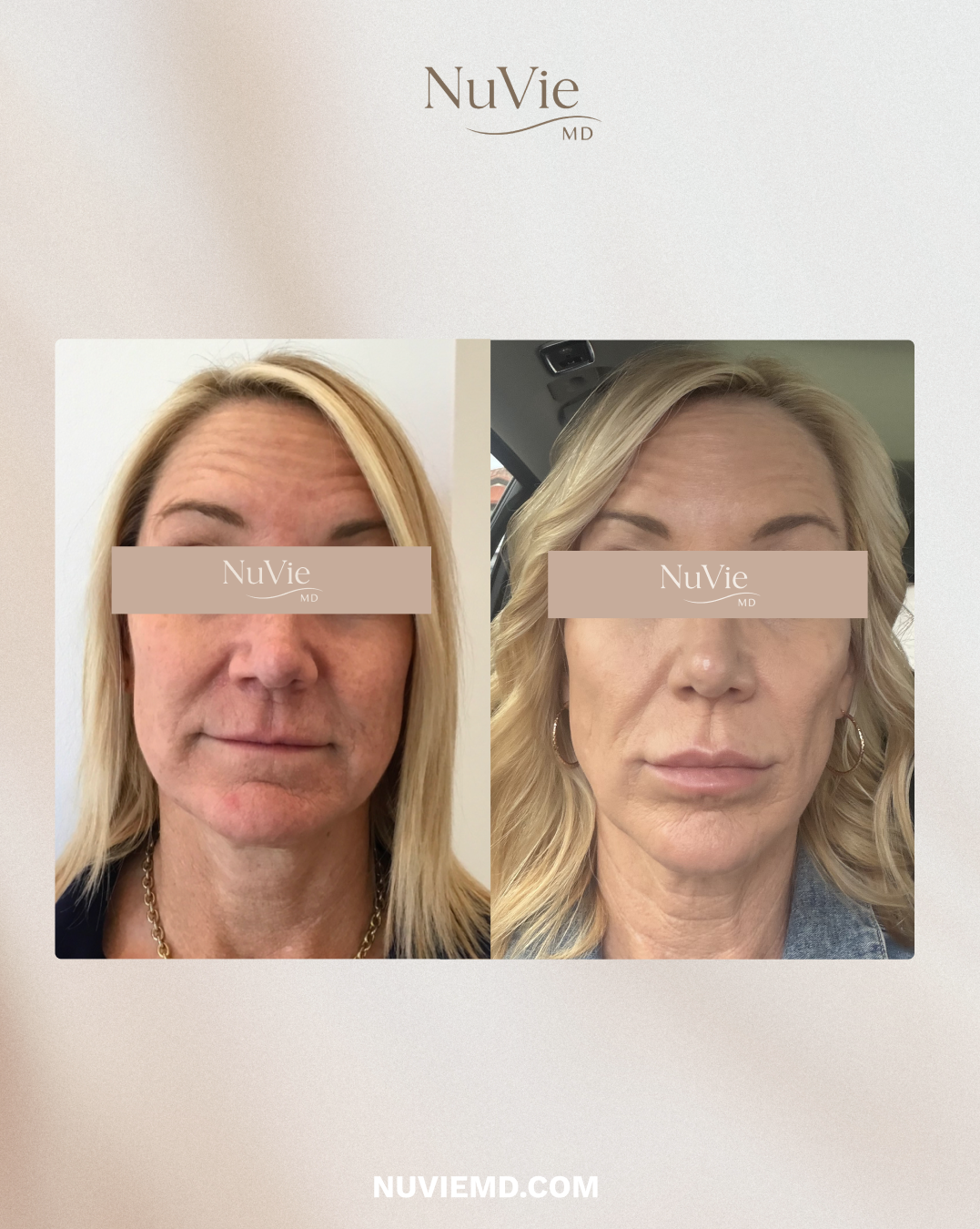 nuviemd.transformation.png