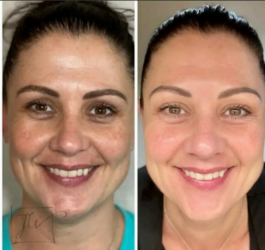 Side-by-side comparison of skin before and after RF microneedling treatment, showing improved skin texture on the right.