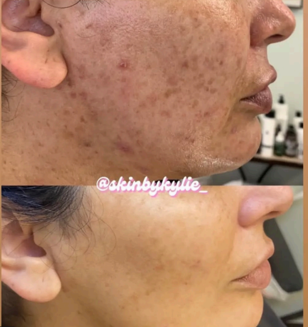 Side-by-side comparison photo showing a man's face before and after RF microneedling treatment. The 'before' image depicts the man with red, uneven skin tone and visible signs of aging. The 'after' image shows smoother, more even skin with reduced redness and fine lines.