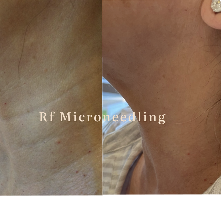 Side-by-side comparison of skin before and after RF microneedling treatment, showing improved skin texture on the right.