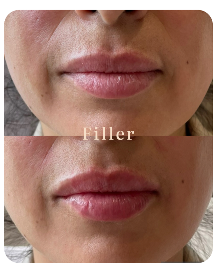 Lip filler before and after at NuVie MD, Irvine — hyaluronic acid filler, results at 2 weeks