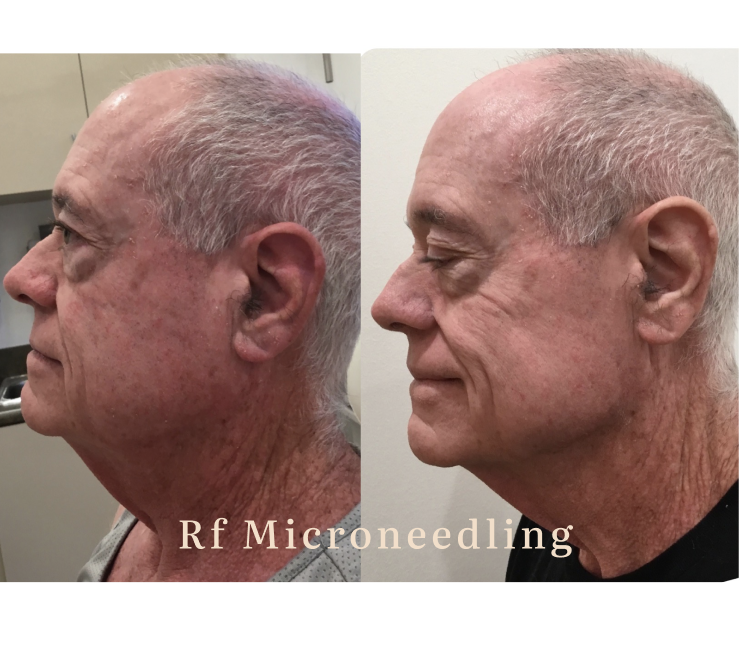 Side-by-side comparison photo showing a man's face before and after RF microneedling treatment. The 'before' image depicts the man with red, uneven skin tone and visible signs of aging. The 'after' image shows smoother, more even skin with reduced redness and fine lines.