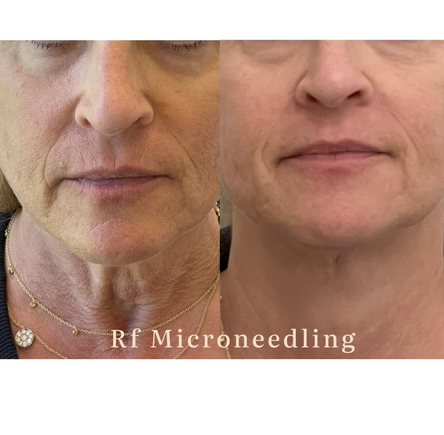 Close-up of a woman's face before and after RF microneedling treatment, showing reduced wrinkles and smoother skin on the right.